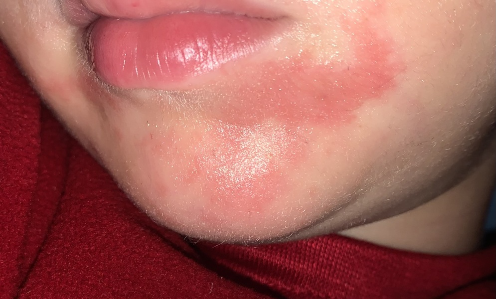 4yo excessive dribbling