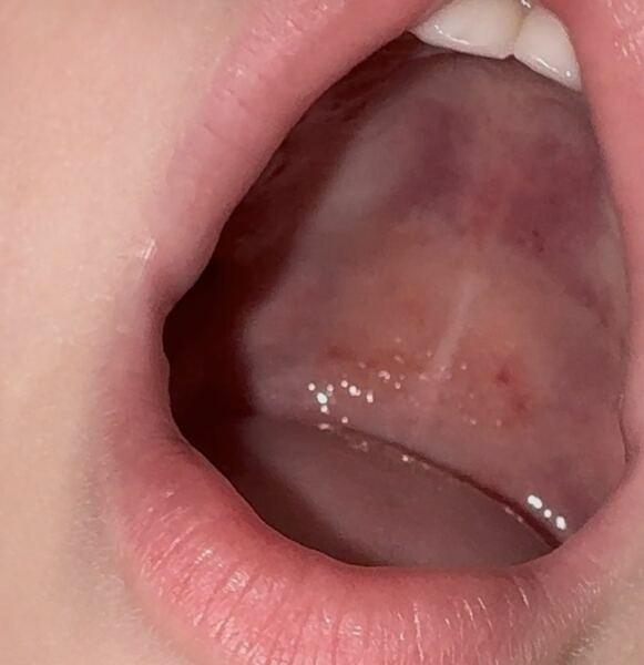 Top of mouth red spot and dots (with picture)