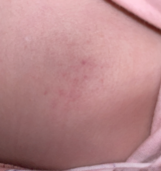 Small patch of what I think is petechiae on DD back. I am spiralling with healt anxiety