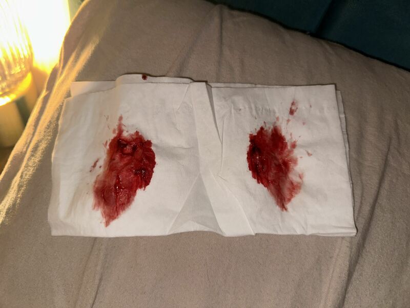blood clot after sinus surgery, what do I do? Picture attached