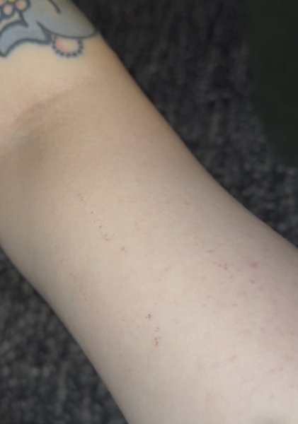 Petechiae from blood pressure cuff?