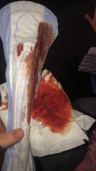 lochia/post partum bleeding helppp