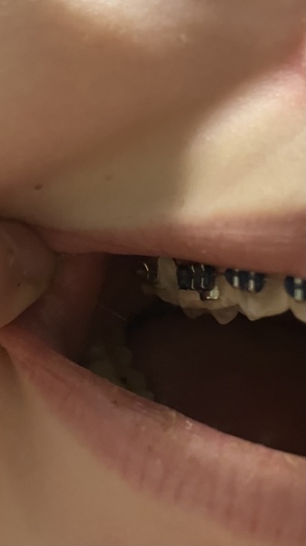 Braces - what the hell has just happened?