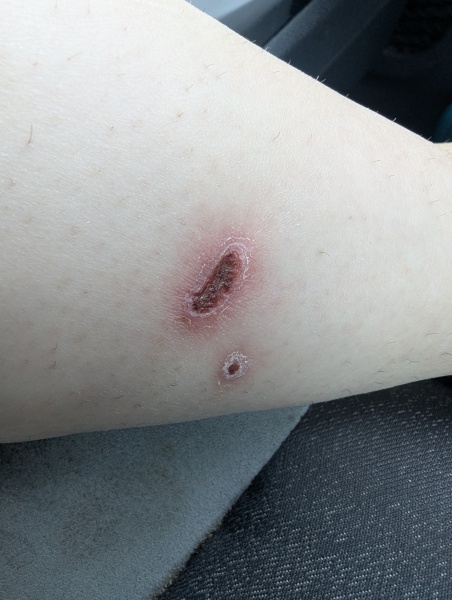 Dog bite making me feel ill?
