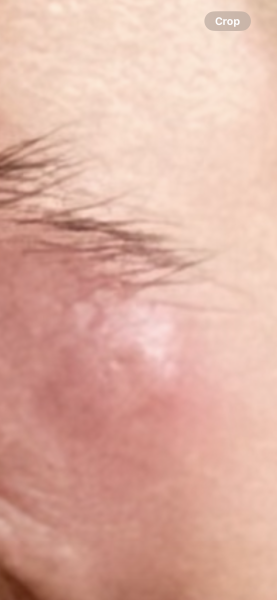 What is this on my eyebrow