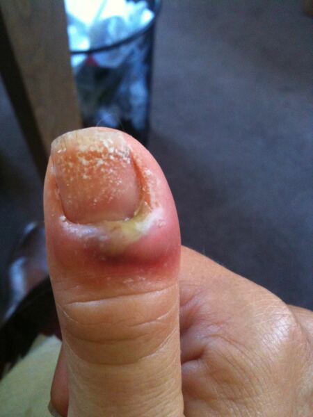 Is my finger infected?