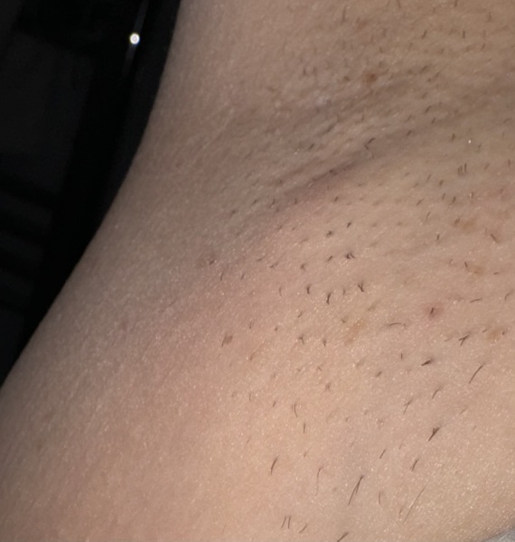 Worried about lump under armpit?