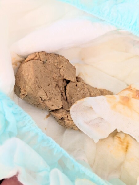 TMI - my son's stools have been an odd colour