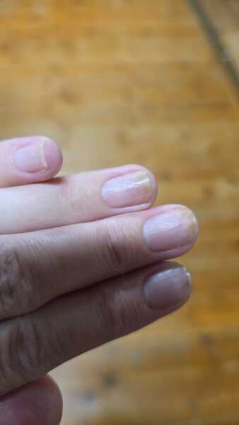 Brown marks on nails