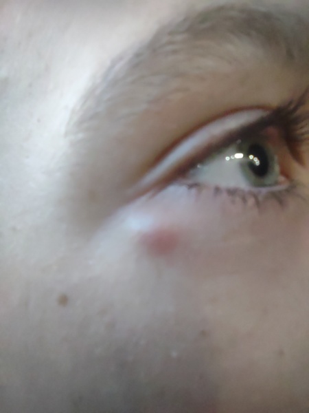 Does this cyst-like lump have a name?