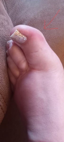 Sore toe with pic