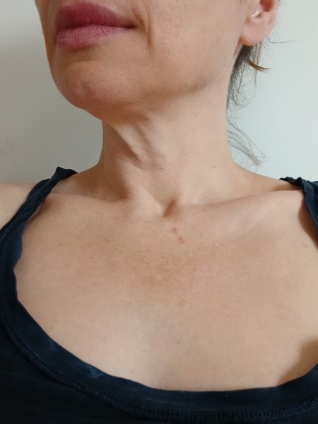 Skin on neck. Mini facelift?