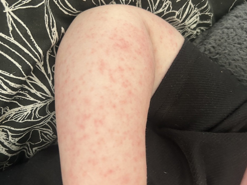 What is this rash?