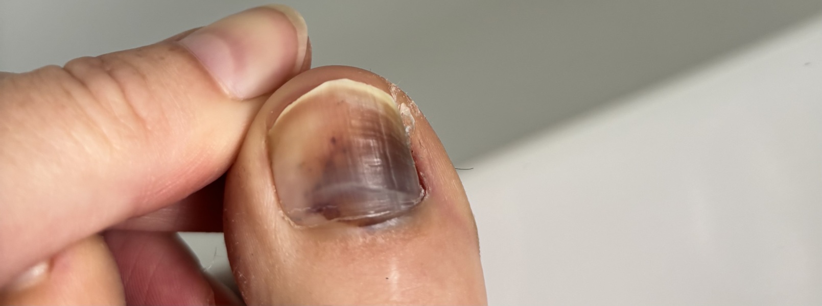 Any dermatologist or podiatrist around?(pic of a toenail in post)