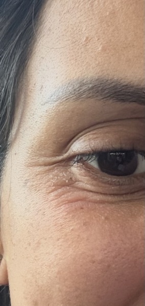 Crows feet Botox - anyone had it done?