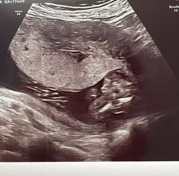 Babys heartbeat+gender!