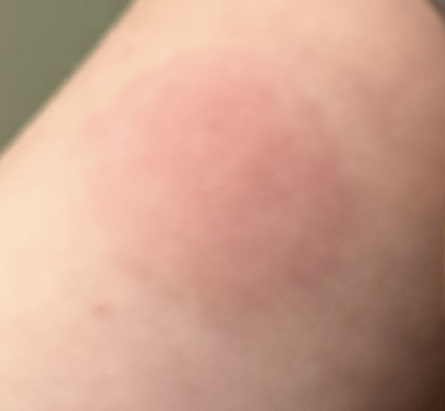 Bullseye rash or normal bite?