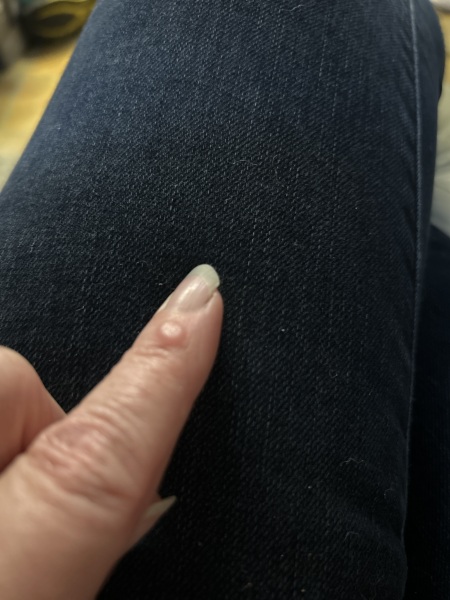 Lump on finger
