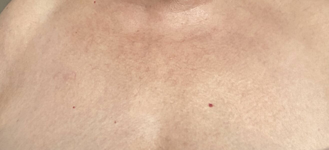 Skin on neck. Mini facelift?