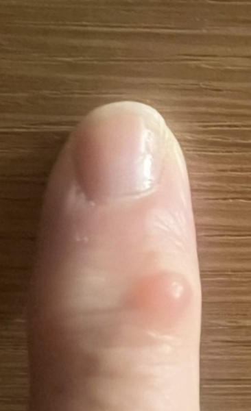 Lump on finger