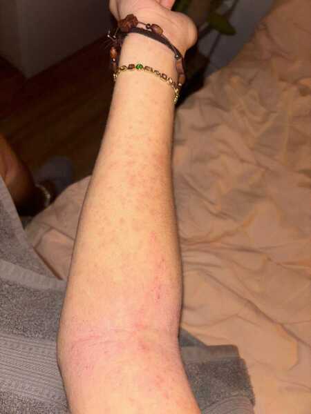 Help Please. Allergic Reaction!