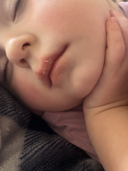 Chapped lips, GP visit?