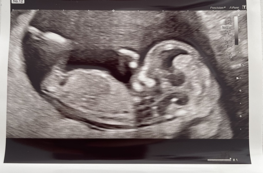 Can you guess the gender of my baby based on nub theory??