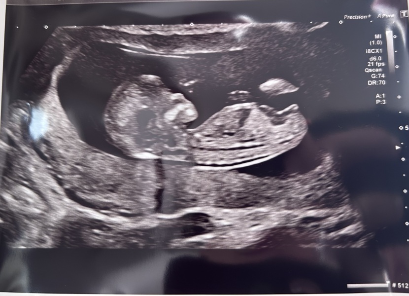 Girl or boy?