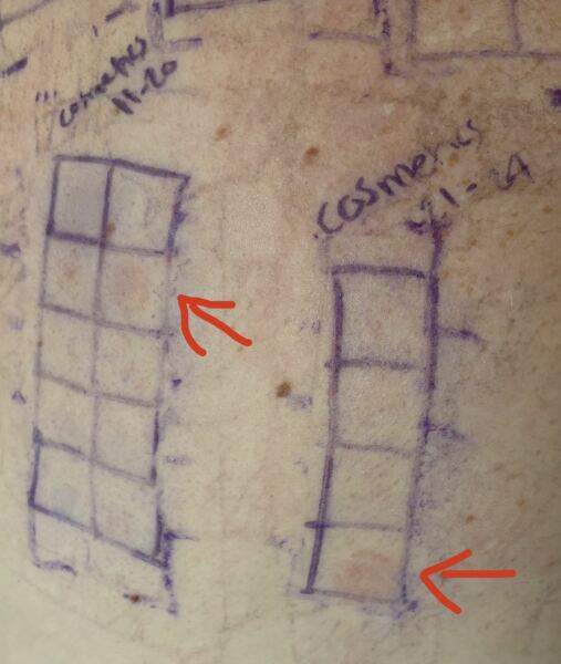 Skin patch test purple pen coming off