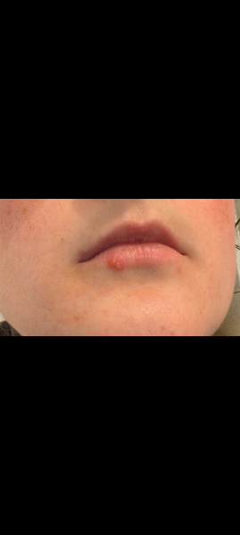 Herpes and 4 month old