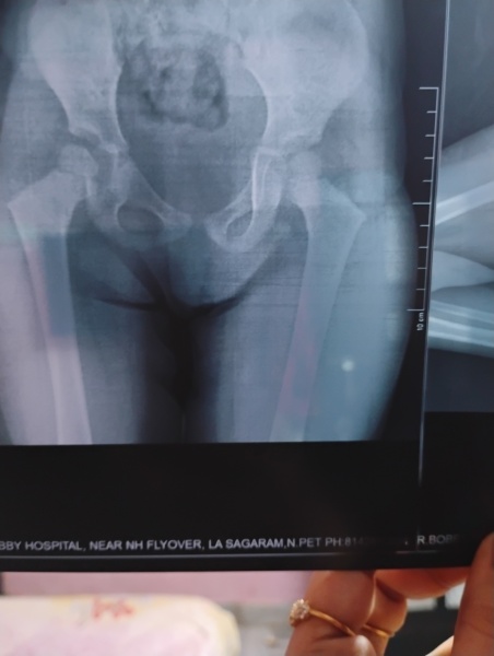 Hip dysplasia
