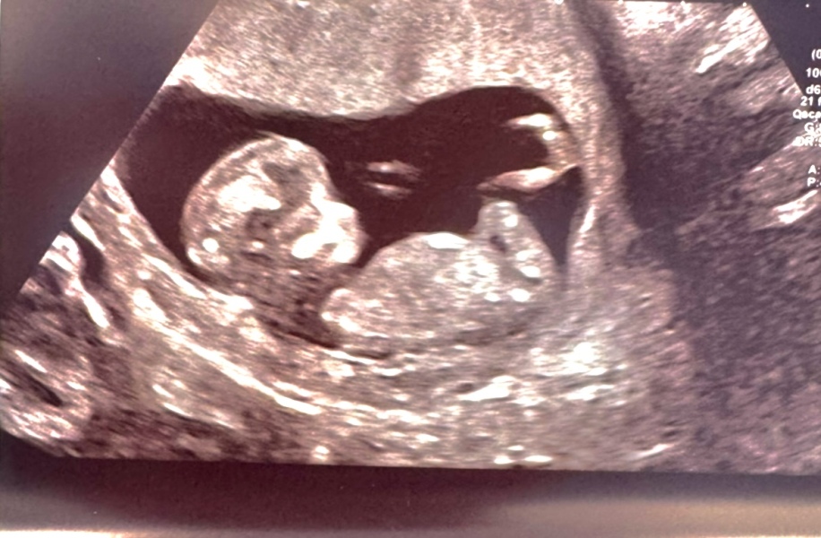 Boy or Girl at 12 weeks