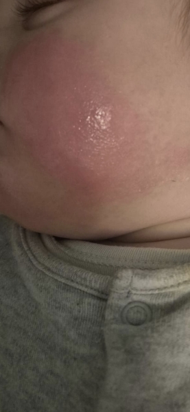 Rash on DS cheeks, teething ?