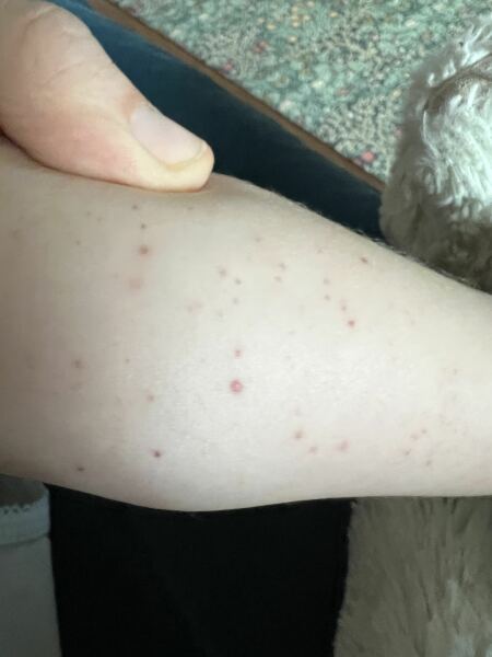 What is this rash?
