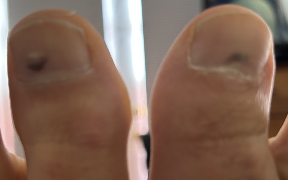 this could be subungual melanoma