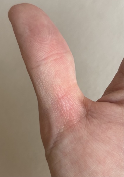I burnt my hand on melted silicone. Does it need medical treatment?