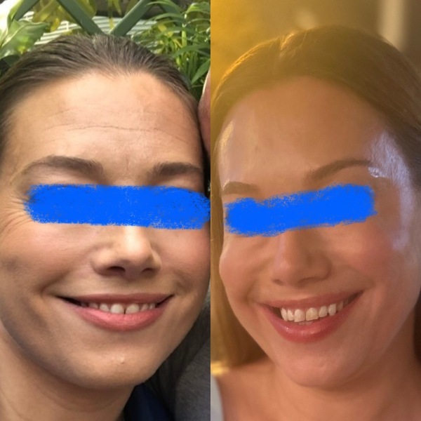 Botox & frozen faces