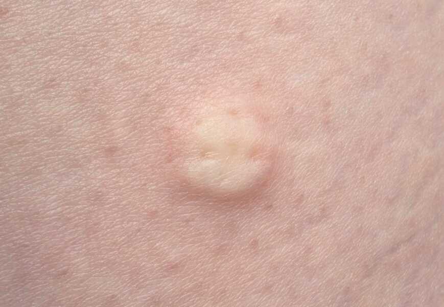 Started Wegovy last week