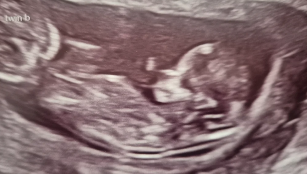 12+4 with twins - nub theory, just for fun!