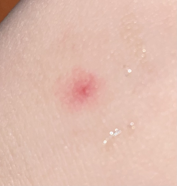 itchy red spot on DD5 hand that isn't going away - I'm not petrified