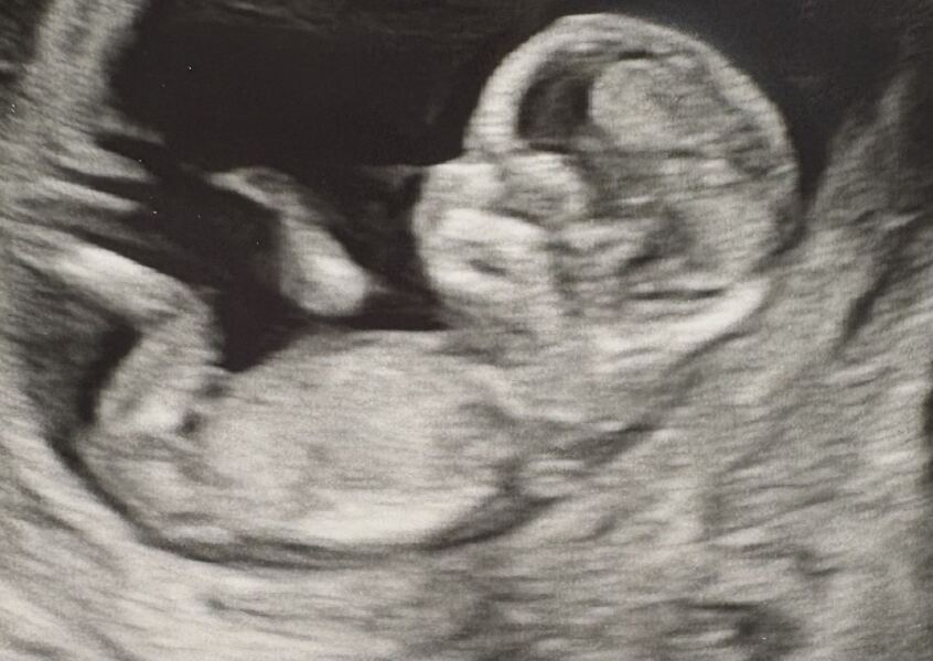 Boy or girl ? 12 week scan