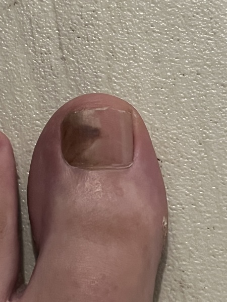 Awaiting biopsy results