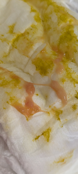 Mucus in poo (5 month old) (WARNING PICTURE ATTACHED)