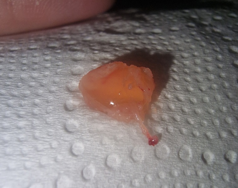 Possible miscarriage TW