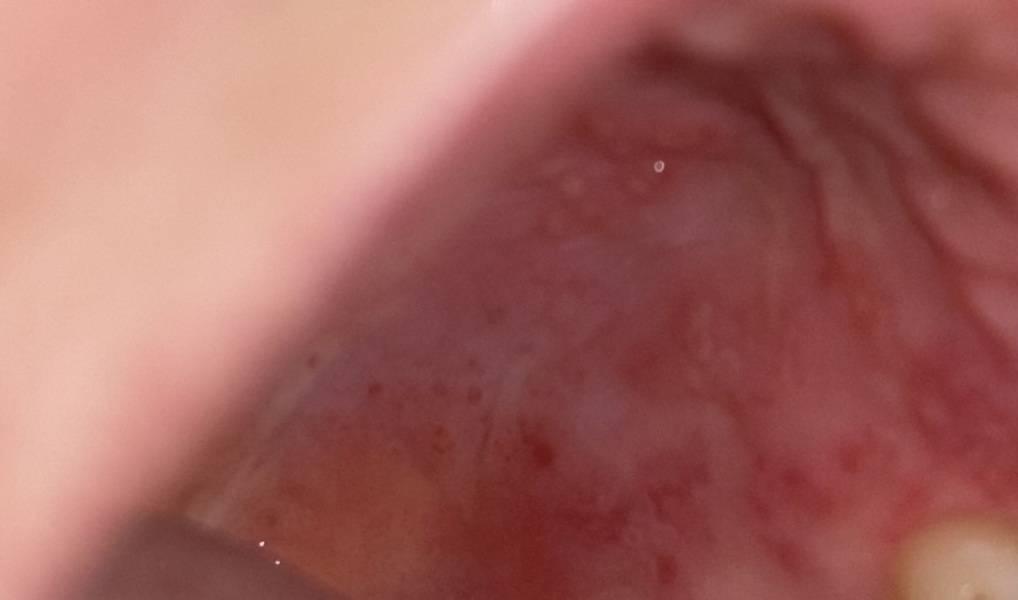 Horrible mouth pic warning. Do i need a dentist ,doctor or pharmacist -help my mouth is driving me insane.