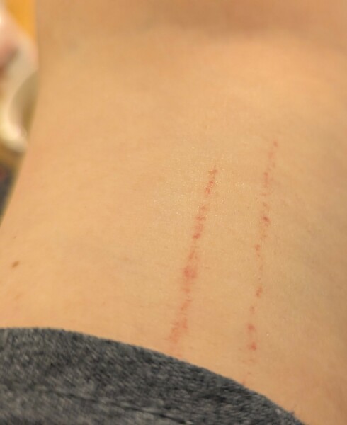 Petechiae from blood pressure cuff?