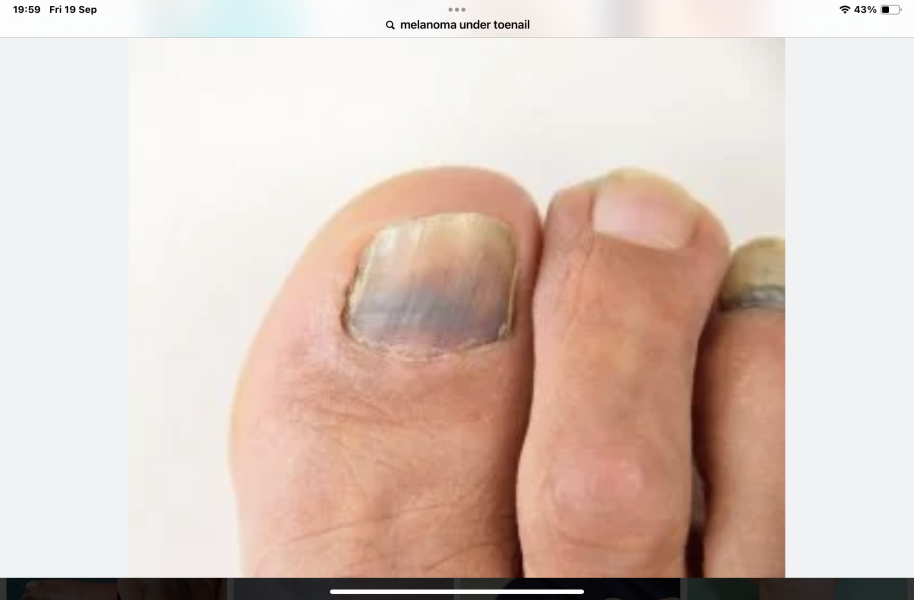 Any dermatologist or podiatrist around?(pic of a toenail in post)