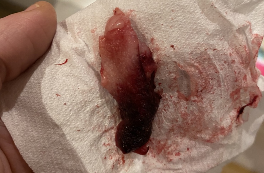 What is this? Is it a miscarriage? *[Content warning: image included]