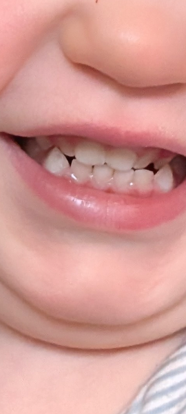 Toddlers teeth are bad due to dummy?