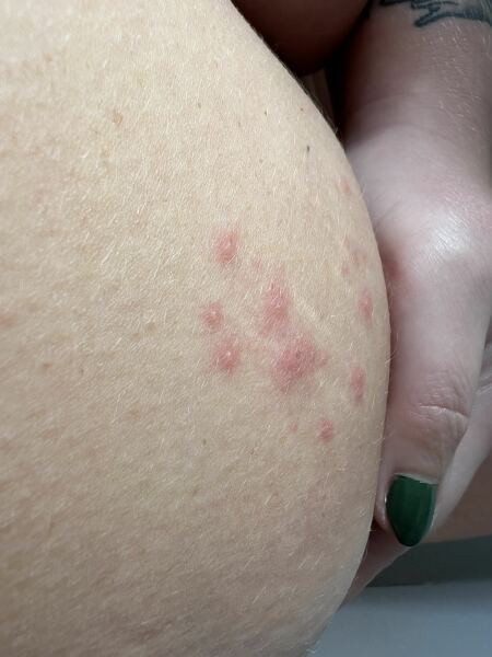 Tiny blisters on breast?